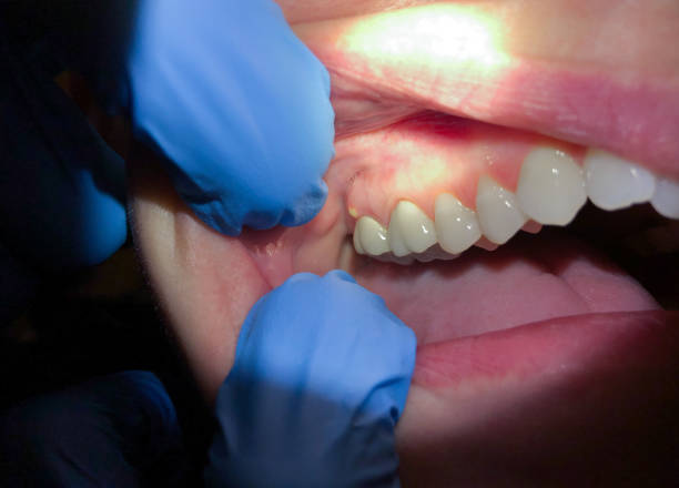 Best Emergency Tooth Extraction in Kennedale, TX