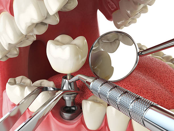 Best Urgent Care for Lost Fillings or Crowns in Kennedale, TX